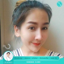 รีวิวทำจมูกผู้หญิงจมูกสวย2021