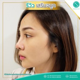 รีวิวเสริมจมูก11_โดดเด่นโดนใจ