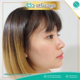 รีวิวเสริมจมูก14_ทำครั้งเดียว_หน้าหวานขึ้นทันที