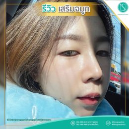  รีวิวเสริมจมูก21_ฮอตจนปรอทแตก
