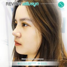 วิวเสริมจมูก23_สวยหวาน_ปลายมน_แบบธรรมชาติ