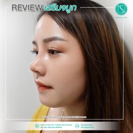 รีวิวเสริมจมูก24_จมูกสโลปต้องมา