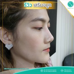 รีวิวเสริมจมูก SongnaeClinic