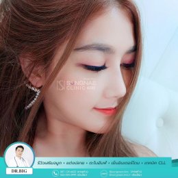 รีวิวเสริมจมูก Songnae