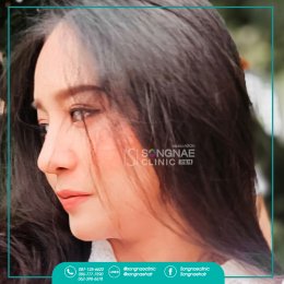  รีวิวเสริมจมูก ผู้หญิง