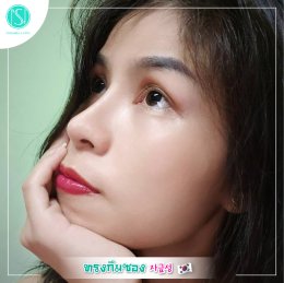 เสริมจมูกทรงกิมซอง
