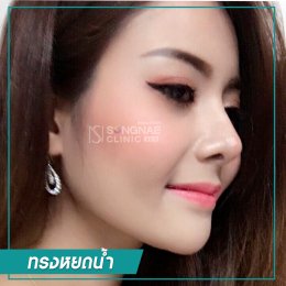 เสริมจมูกทรงหยดน้ำ