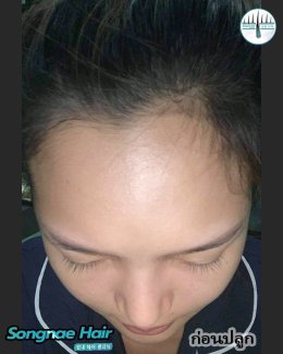 รีวิวก่อนปลูกผมถาวร FUE