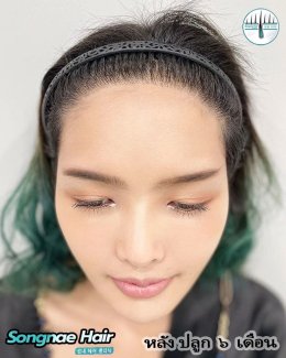 A รีวิวหลังปลูกผมถาวร FUE