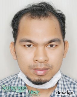 รีวิวก่อนปลูกผมถาวร FUE