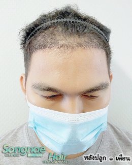 รีวิวหลังปลูกผมถาวร FUE