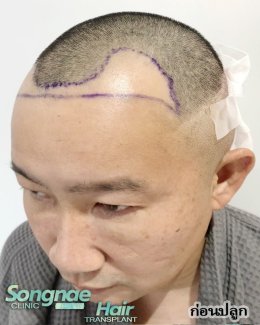 รีวิวหลังปลูกผมถาวร FUE