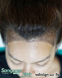 SongnaeHair Transplant