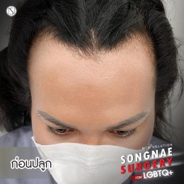 รีวิวก่อน-หลัง ปลูกผมถาวรFUE