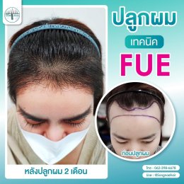รีวิวก่อน-หลัง ปลูกผมถาวรFUE