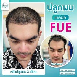 รีวิวก่อน-หลัง ปลูกผมถาวรFUE