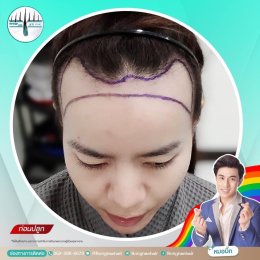 รีวิวก่อน-หลัง ปลูกผมถาวรFUE