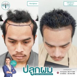 รีวิวก่อน-หลัง ปลูกผมถาวรFUE