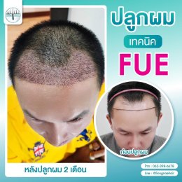 รีวิวก่อน-หลัง ปลูกผมถาวรFUE