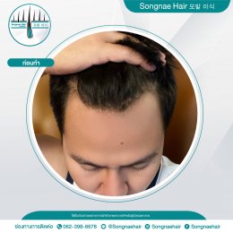  Songnae Clinic x Hair Transplant