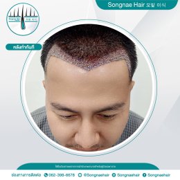  Songnae Clinic x Hair Transplant