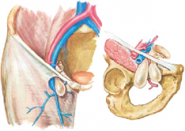  femoral hernia