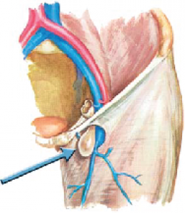 ไส้เลื่อนบริเวณต่ำกว่าขาหนีบ femoral hernia