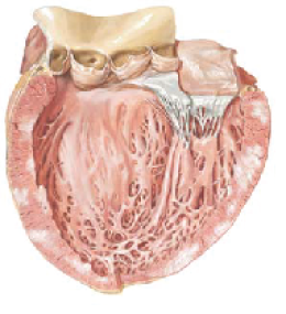 myocarditis