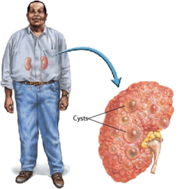 polycystic kidney disease โรคถุงน้ำที่ไต