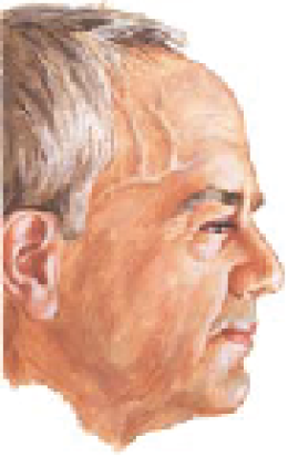Giant Cell Arteritis