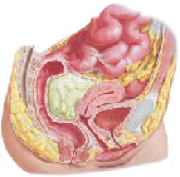 ฝีในอุ้งเชิงกราน Pelvic Abscess