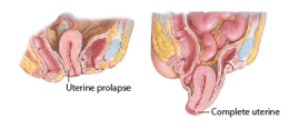  Pelvic Organ Prolapse