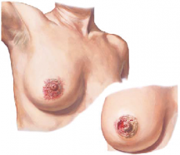 PAGET’S DISEASE OF THE BREAST
