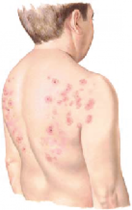 Dermatitis herpetiformis โรคตุ่มน้ำใส