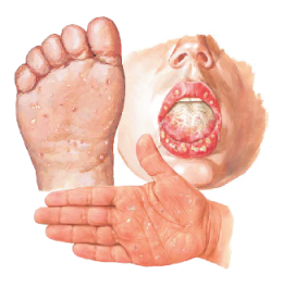 Hand, Foot, and Mouth Disease โรคมือเท้าปาก