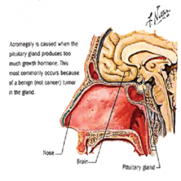 ACROMEGALY