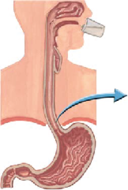 มะเร็งหลอดอาหาร(esophageal cancer)