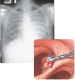 ปอดอักเสบจากนิวโมซิสติส(Pneumocystis pneu- monia)