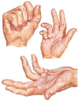Dupuytren’s Contracture