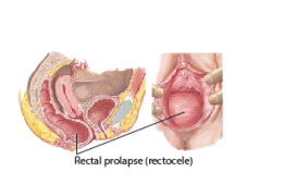 อวัยวะอุ้งเชิงกรานหย่อน Pelvic Organ Prolapse