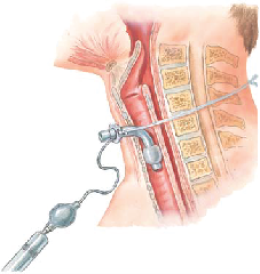 oral cancer