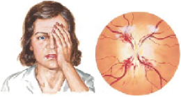 Giant Cell Arteritis หลอดเลือดแดงใหญ่อักเสบ