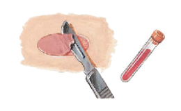 Erythema multiforme