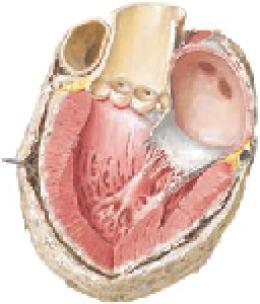 Pericarditis