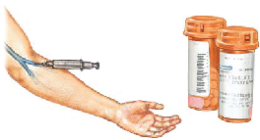 Giant Cell Arteritis
