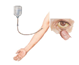 Pancreatitis ตับอ่อนอักเสบ