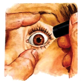 ACROMEGALY