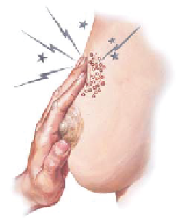  fibrocystic