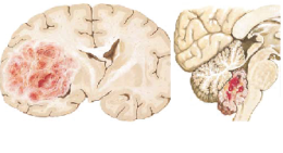 brain cancer