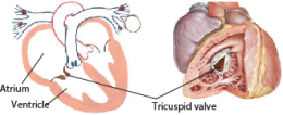 TRICUSPID REGURGITATION